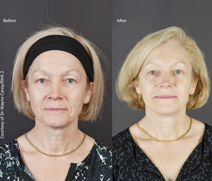 dermal-fillers-before-after-2