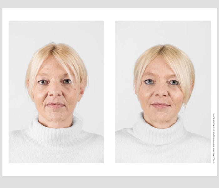 dermal-fillers-before-after-4